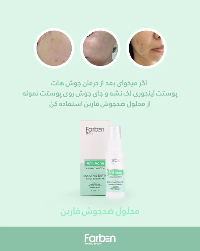 محلول ضد جوش فاربن